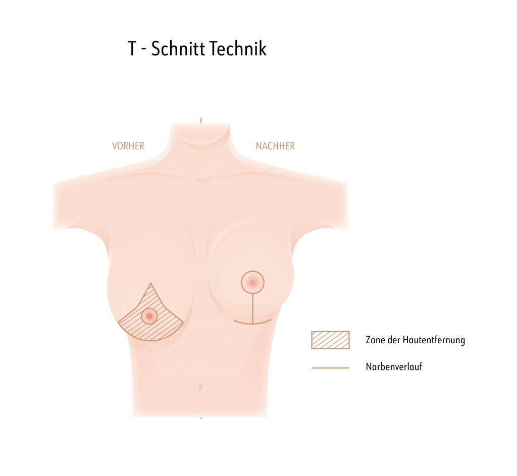 Bruststraffung mit der T-Schnitt Technik